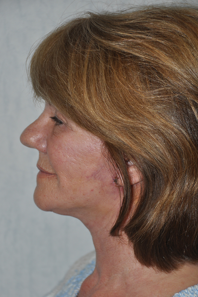 View 3 — after (post-operative)